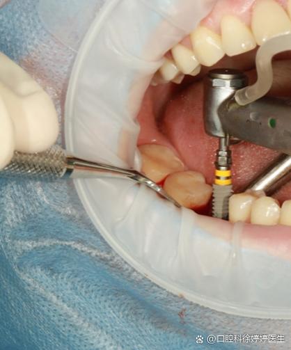 植牙骨后嘴巴干燥是什么原因？该如何有效缓解？-图3