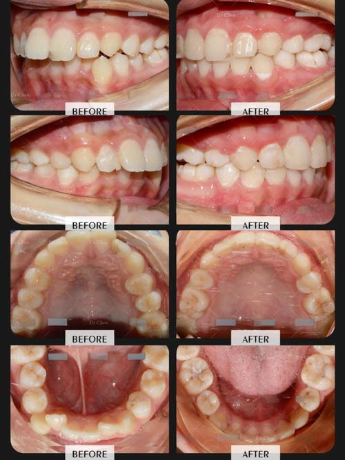 正畸矫正凸嘴，究竟能改善几毫米？-图3