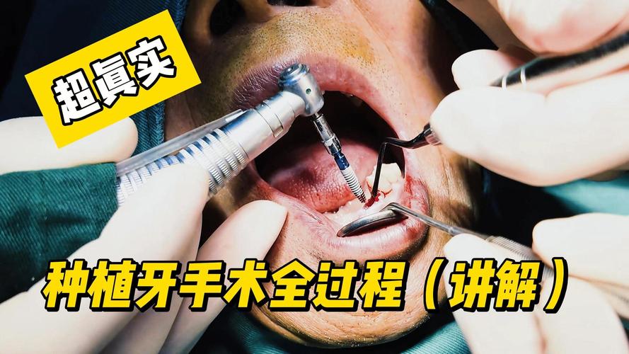 口腔植牙手术视频-图2 口腔植牙手术视频-图2