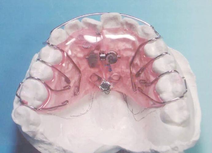 正畸4 6矫治技术是什么？效果与传统有何不同？-图1