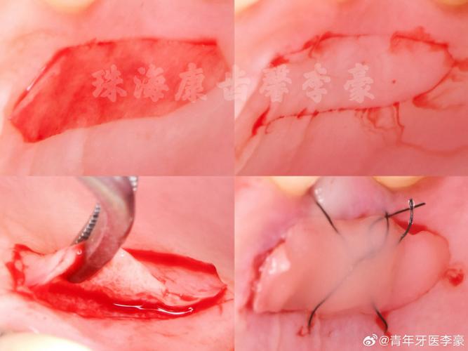 种牙 植骨 白色-图1