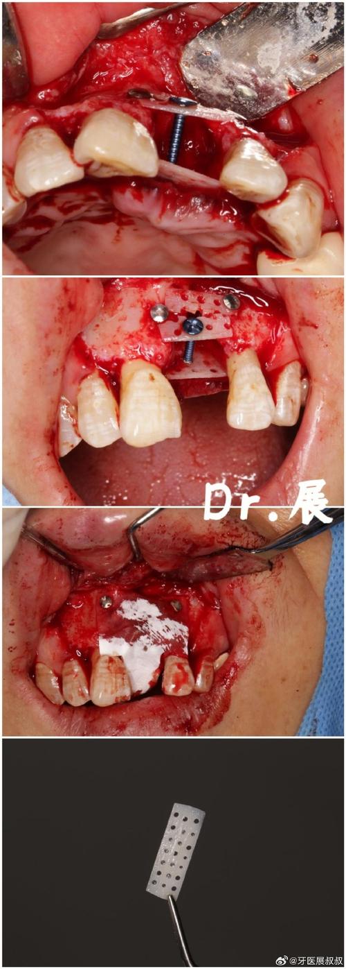 种牙 植骨 白色-图3