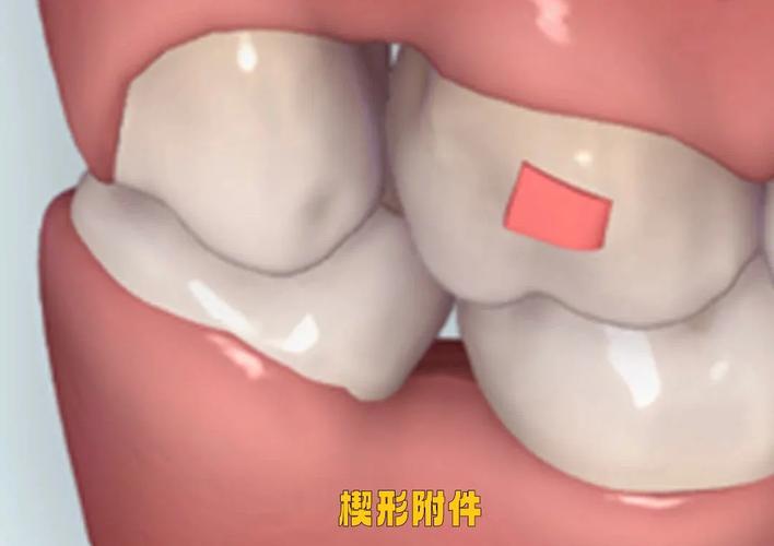 自己在家粘正畸附件-图1