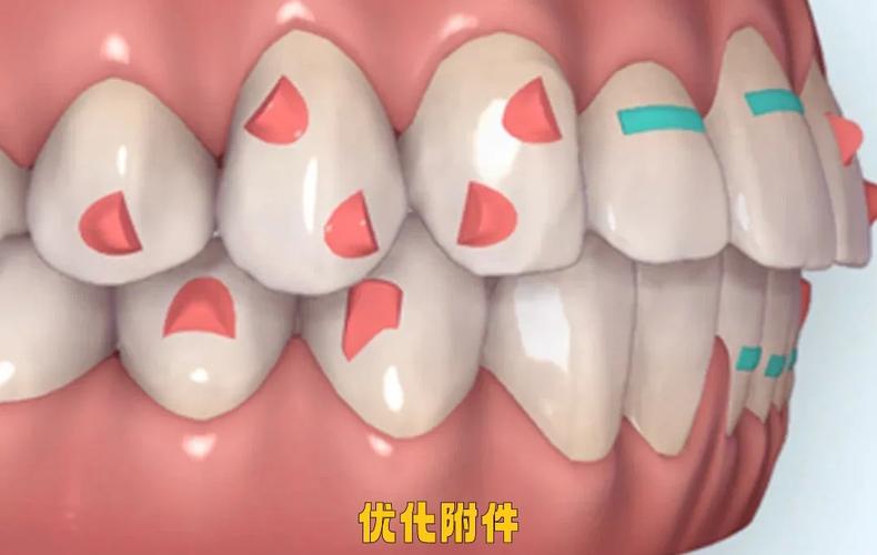 自己在家粘正畸附件-图2