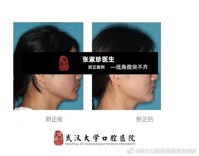 正畸拔牙后脸部塌陷-图2