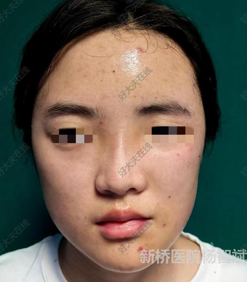 正畸拔牙后脸部塌陷-图3