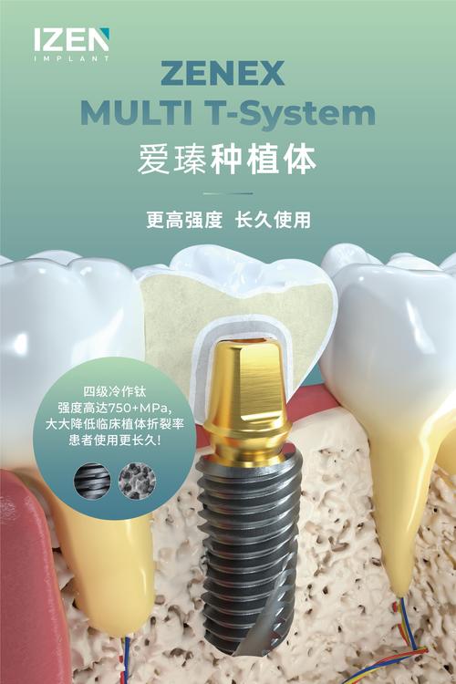 韩国植牙品牌好吗-图3 韩国植牙品牌好吗-图3