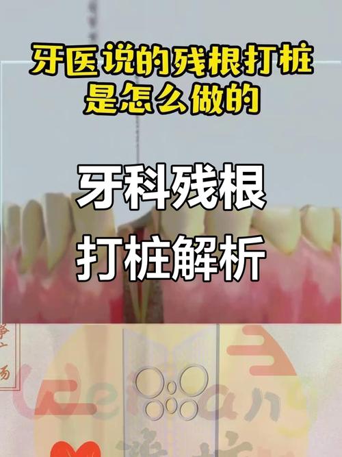 植牙打桩桩体松动-图2