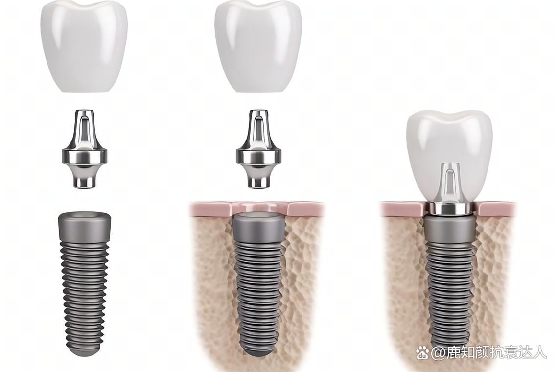 成都哪里植牙最好-图1