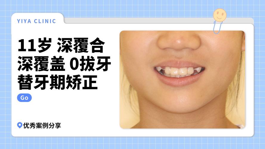 牙齿正畸过程深覆盖-图3