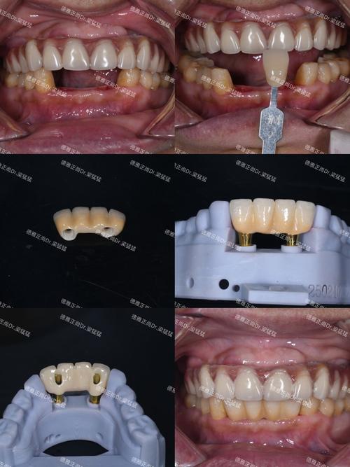 植牙什么材质最好-图3