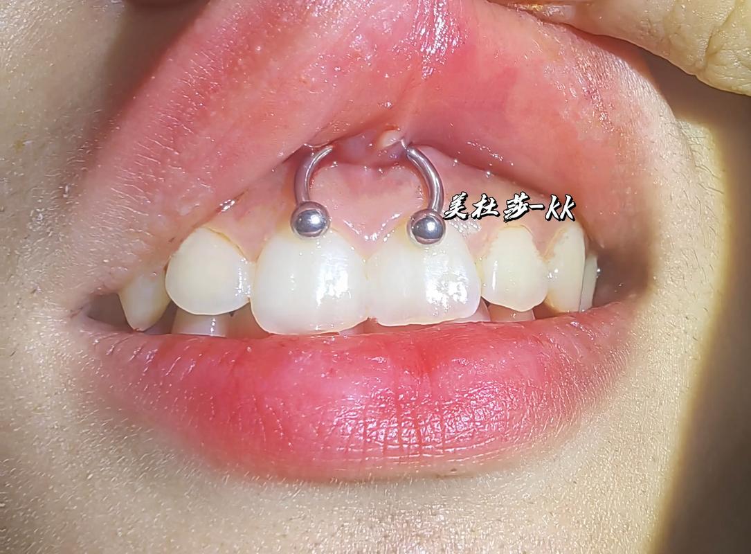 植牙的牙钉哪个好-图2