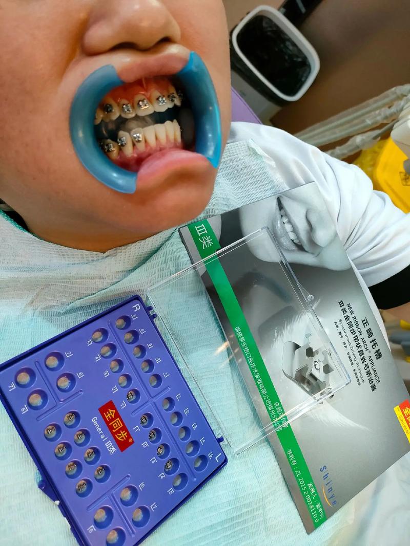 天津成年反颌正畸可行吗？效果与注意事项有哪些？-图3