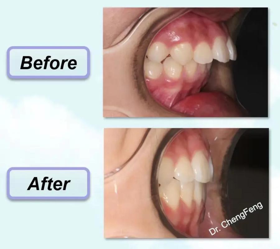 美国 正畸 没拔牙-图2