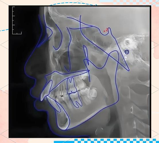 正畸SN MP角度-图3 正畸SN MP角度-图3