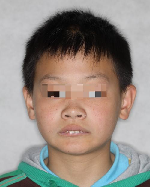 上海 儿童口腔正畸-图3