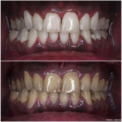 正畸后牙齿色素沉积,原因是什么?如何清除?-图1 正畸后牙齿色素沉积,原因是什么?如何清除?-图1