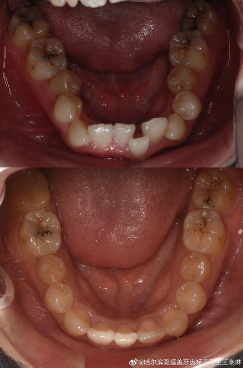 正畸后牙齿色素沉积，原因是什么？如何清除？-图2