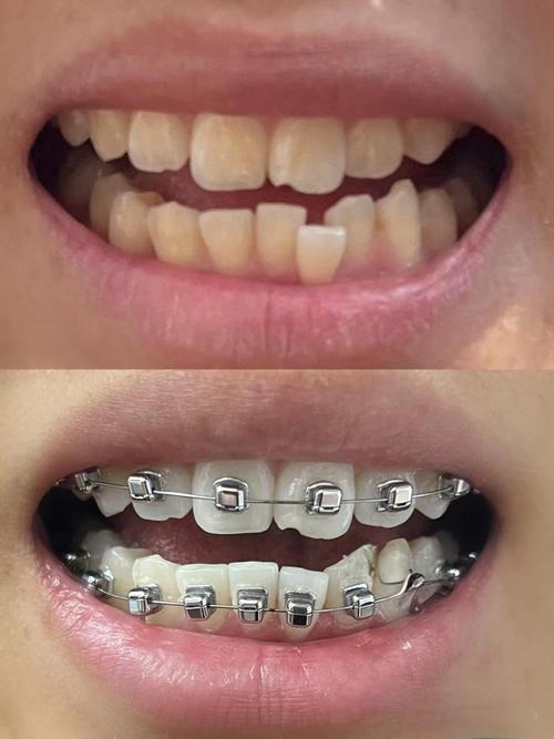 3wubegg正畸效果如何？适合哪些牙齿问题人群？-图1