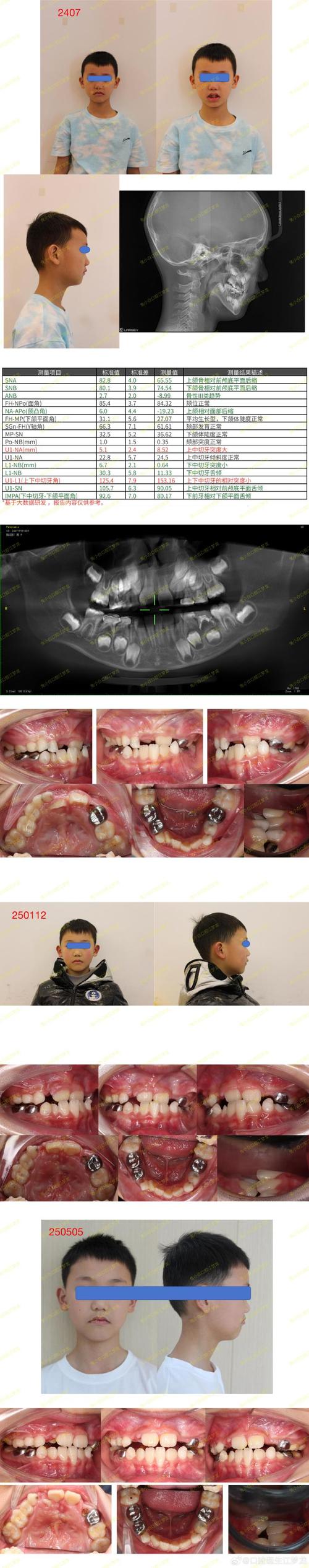 正畸 牙 侧面 裂-图3