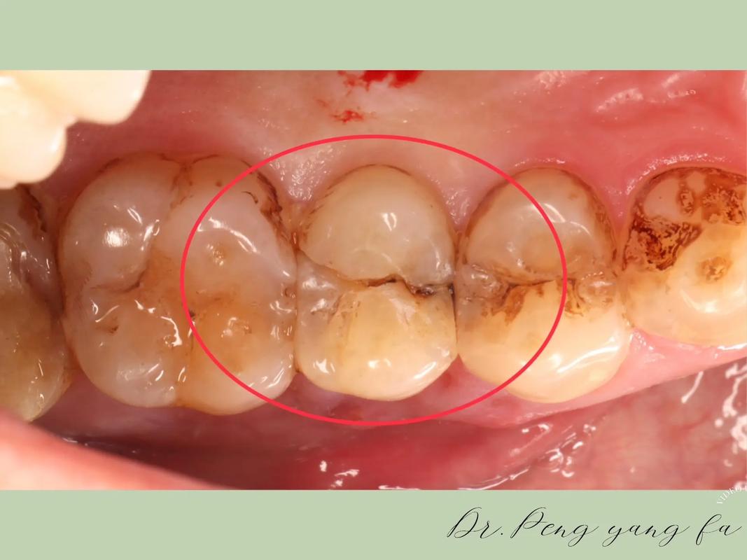 正畸 牙 侧面 裂-图2
