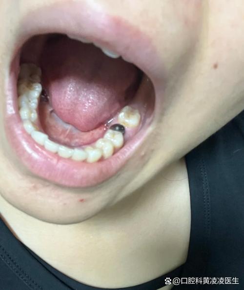 拔牙后一年种植牙，为何要间隔这么久？-图3