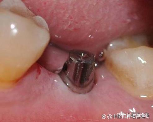 牙植骨手术 恢复-图1