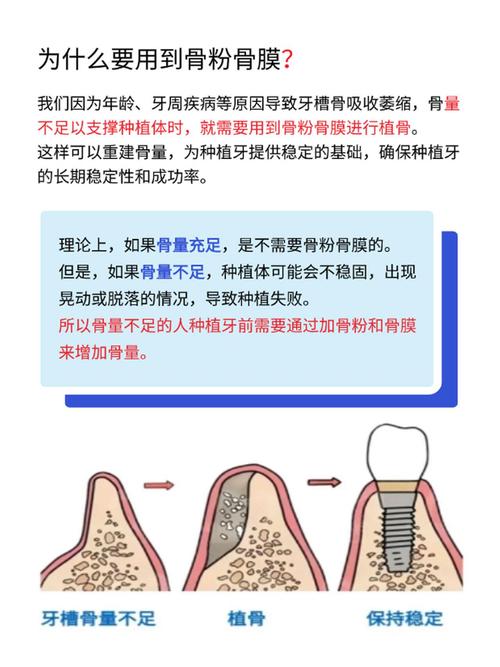 种植牙植骨成功率受哪些关键因素影响？-图2