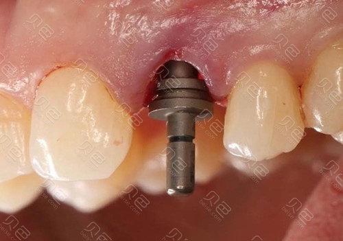 上海口腔医院植牙-图2