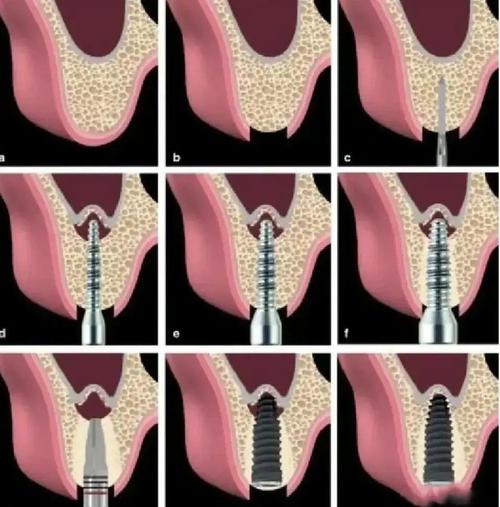 种植牙植骨疼不疼？手术过程和术后疼痛情况如何？-图1