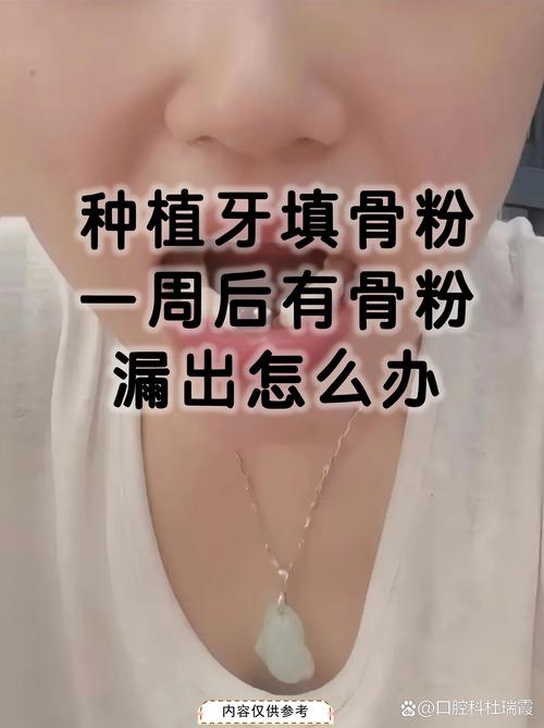 骨粉植牙失败，背后原因究竟是什么？-图1