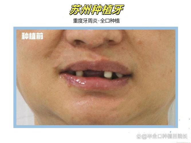 骨粉植牙失败，背后原因究竟是什么？-图3