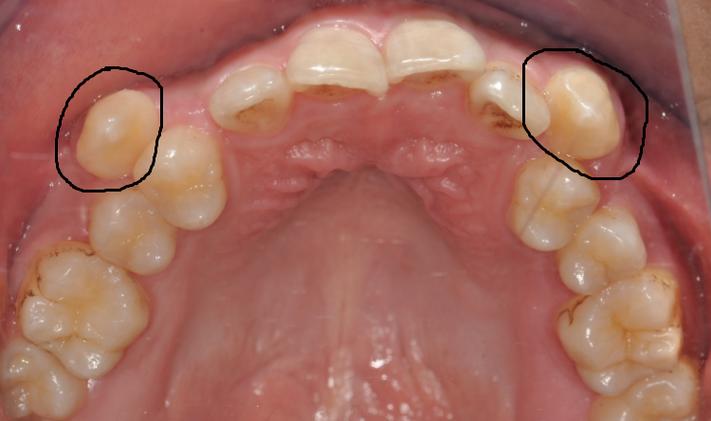 正畸拔虎牙真的有必要吗？会对牙齿和脸型有影响吗？-图2