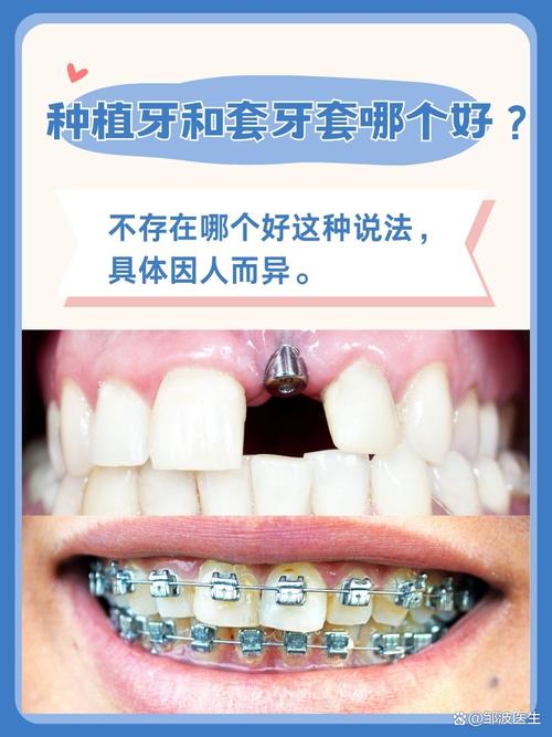 植牙好还是套牙好-图1 植牙好还是套牙好-图1
