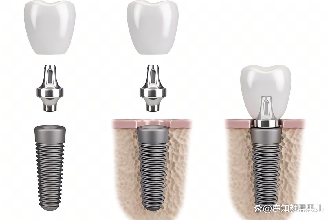 广州植牙价钱柏德-图1