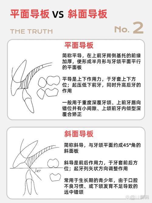 牙正畸导板会影响说话清晰度吗？-图1