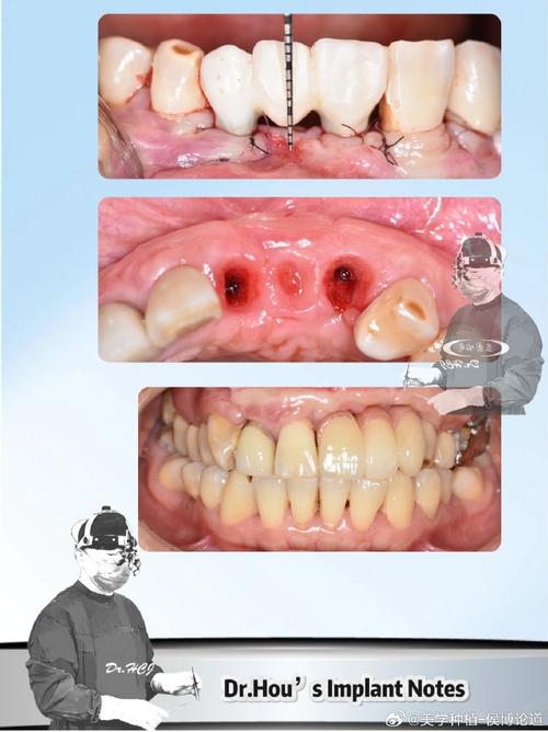 第一期植牙失败，究竟是什么原因？后续治疗该如何补救？-图3