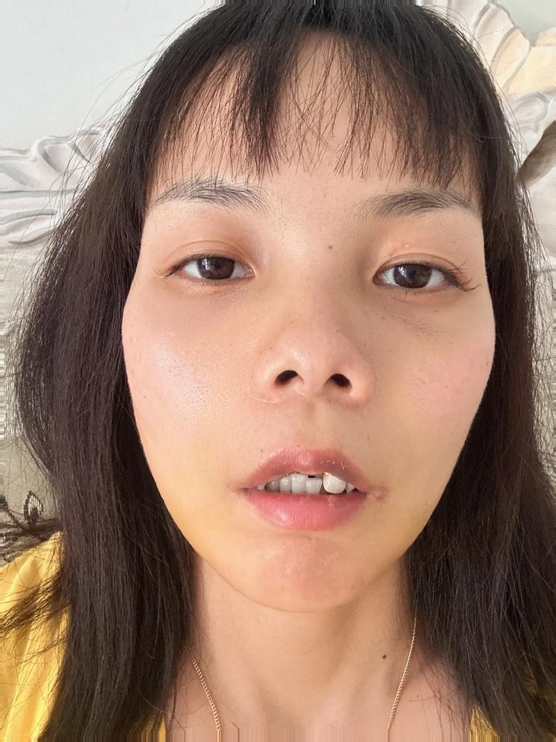 植完牙脸一直肿-图1