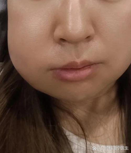 植完牙脸一直肿-图2