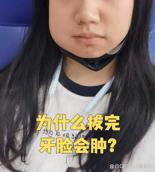 植完牙脸一直肿-图3