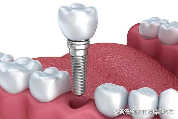 衡阳附二种植牙怎么样?价格和技术靠谱吗?-图2 衡阳附二种植牙怎么样?价格和技术靠谱吗?-图2