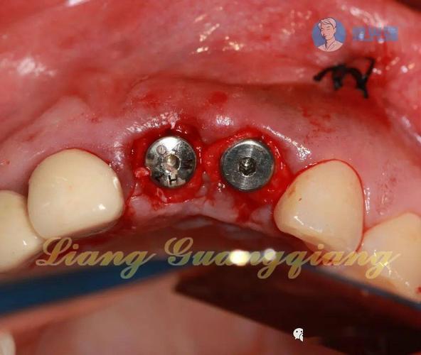 种牙植骨什么人-图2 种牙植骨什么人-图2