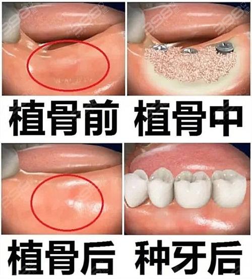 种牙植骨什么人-图3 种牙植骨什么人-图3
