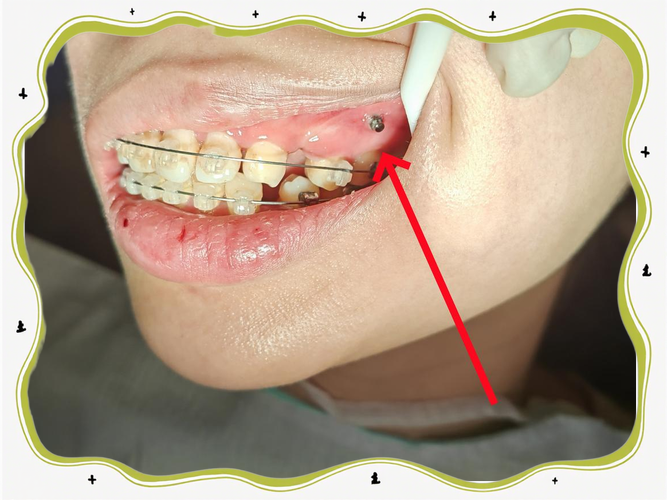 正畸带环粘接剂脱落-图1