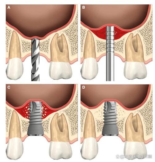 牙槽骨外提植骨是什么?安全与效果如何?-图2 牙槽骨外提植骨是什么?安全与效果如何?-图2