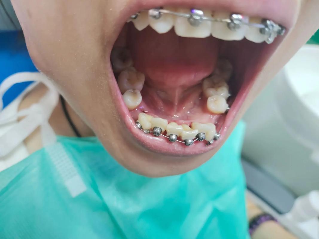 正畸托槽拆除 视频-图3 正畸托槽拆除 视频-图3