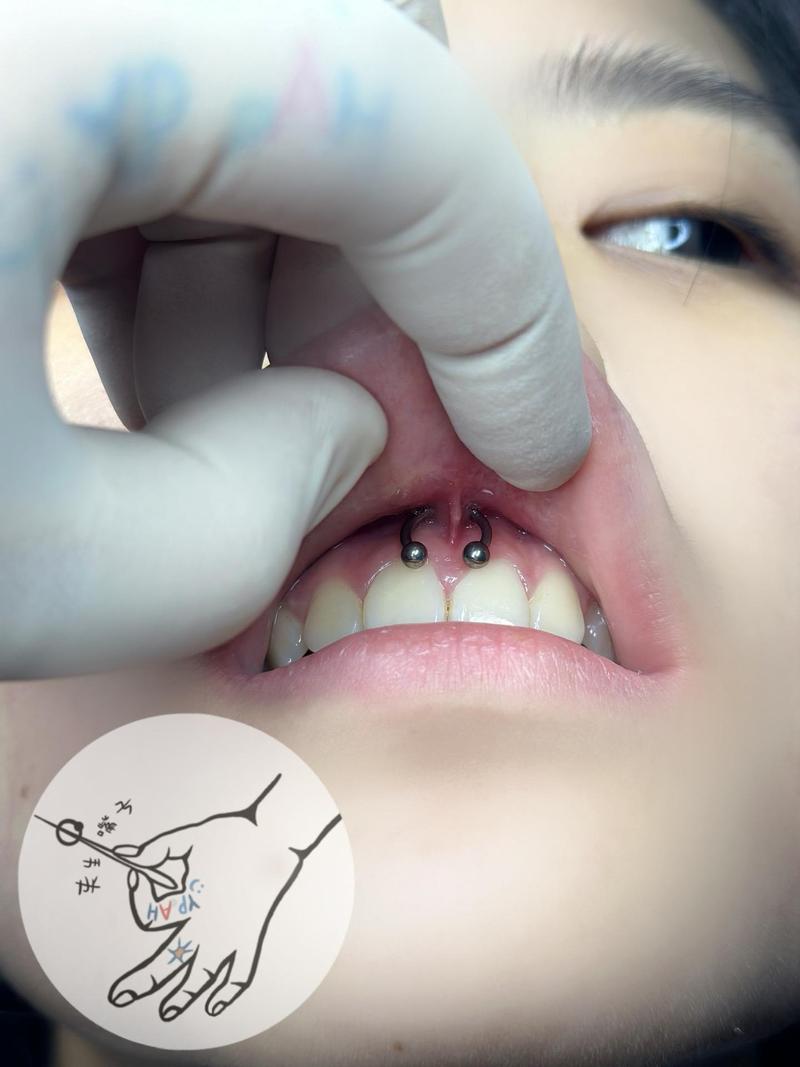 种牙植体后打钉-图2