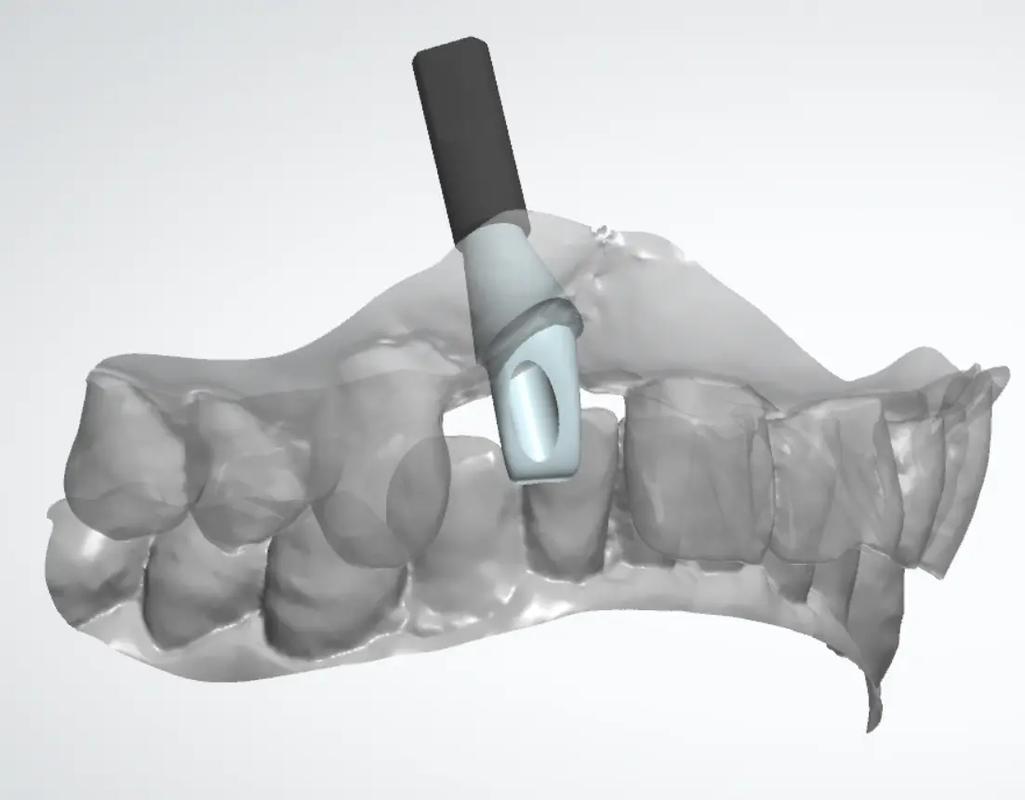 植牙个性化基台-图1 植牙个性化基台-图1