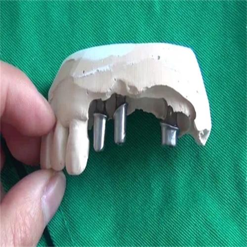 植牙个性化基台-图3 植牙个性化基台-图3