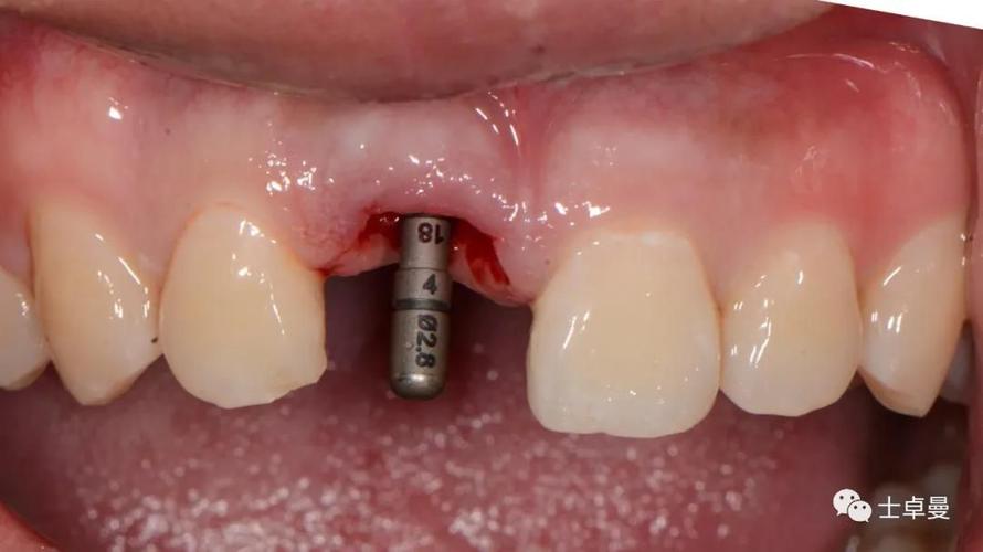 植牙个性化基台-图2 植牙个性化基台-图2